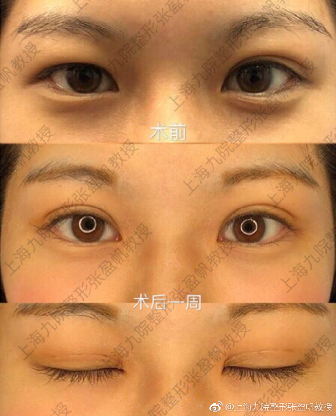 張盈帆割雙眼皮案例