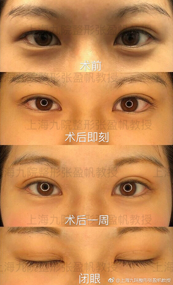 張盈帆割雙眼皮案例