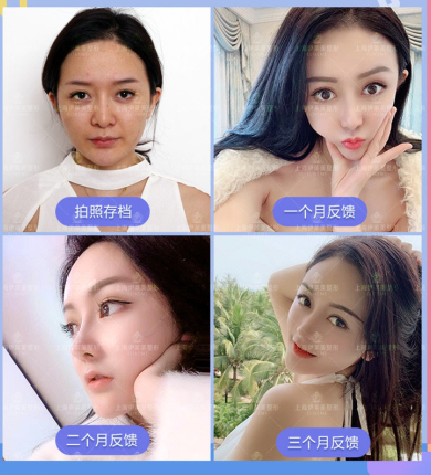 錢玉鑫隆鼻案例