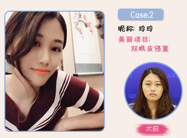 周長兵雙眼皮修復