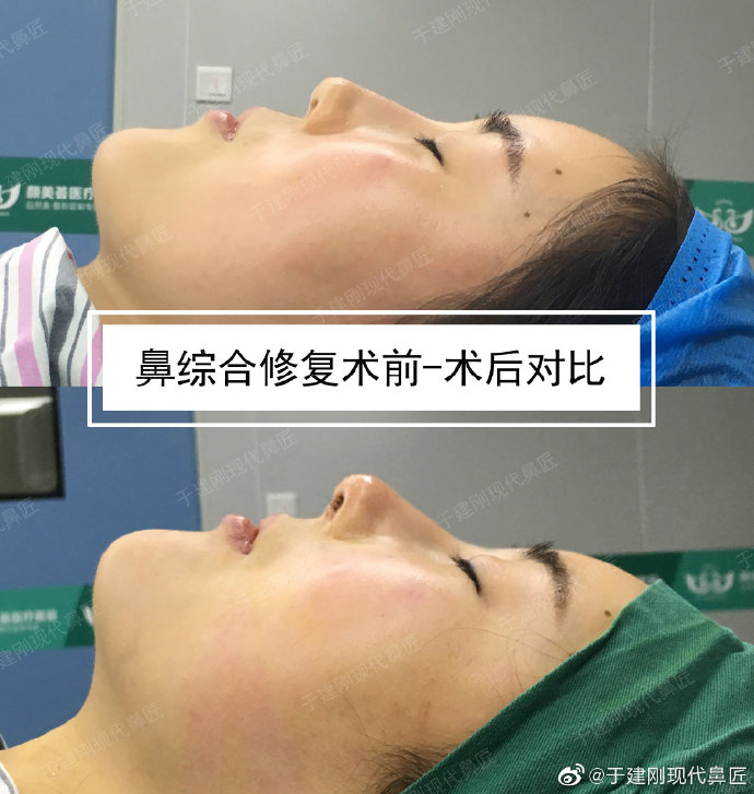 于建剛鼻修復案例