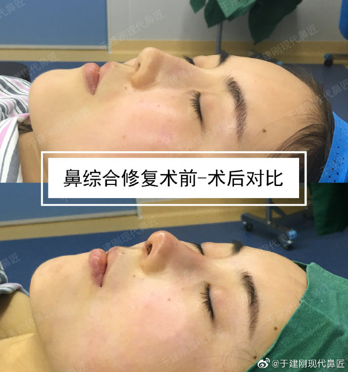 于建剛鼻修復案例