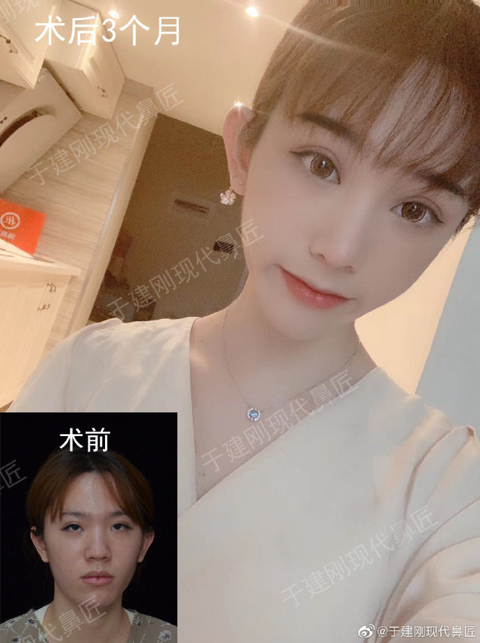 于建剛鼻修復案例
