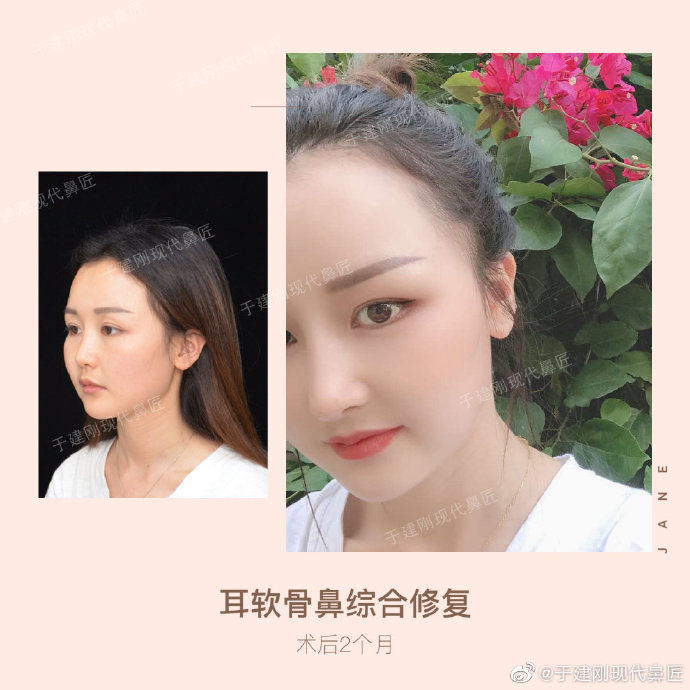 于建剛鼻修復