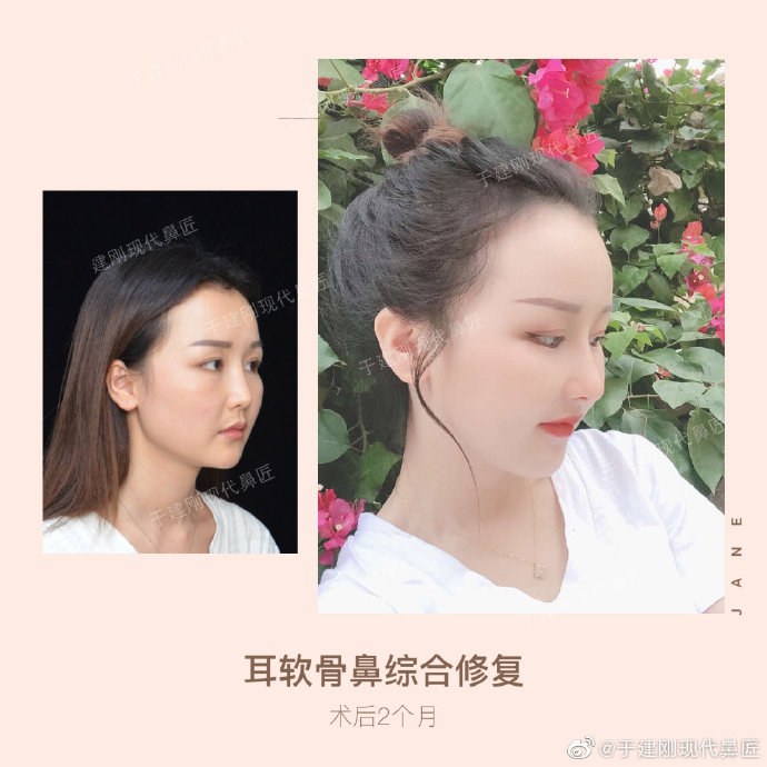 于建剛鼻修復案例
