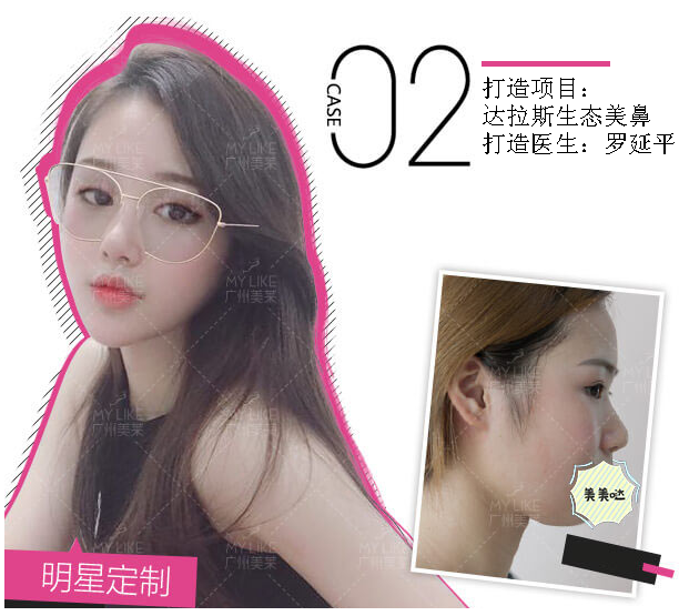 羅延平肋骨做鼻子好嗎?鼻綜合效果好不好?