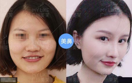 羅延平美鼻案例