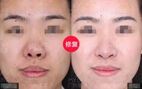 羅延平美鼻案例