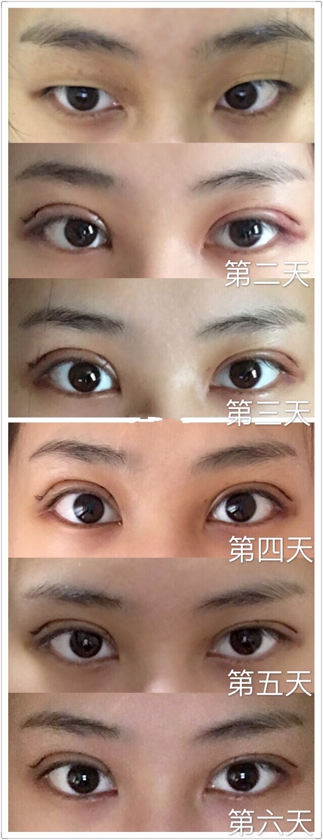 朱慧敏雙眼皮案例