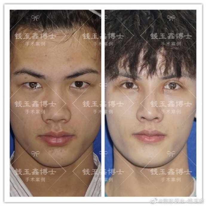 錢玉鑫隆鼻