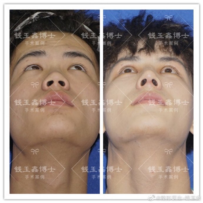 錢玉鑫隆鼻
