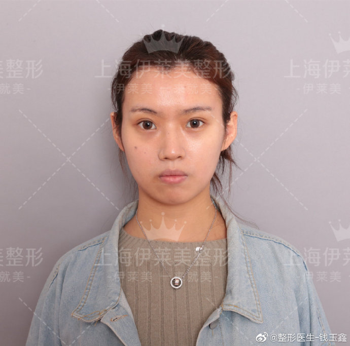 錢玉鑫隆鼻案例