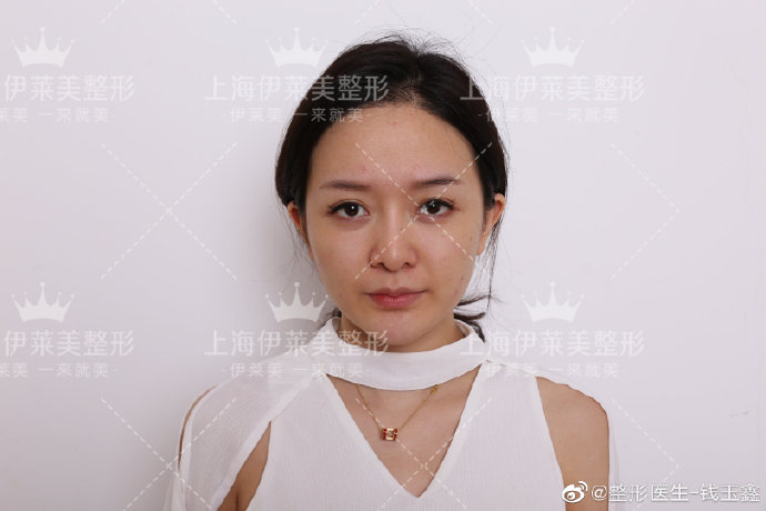 錢玉鑫隆鼻案例