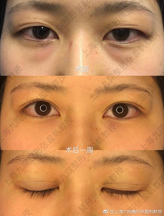 上海九院做眼綜合大概多少錢？哪個醫生最好？