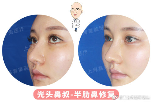 王會勇鼻修復案例