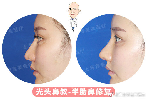 王會勇鼻修復案例