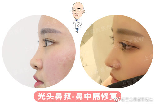 王會勇鼻修復案例
