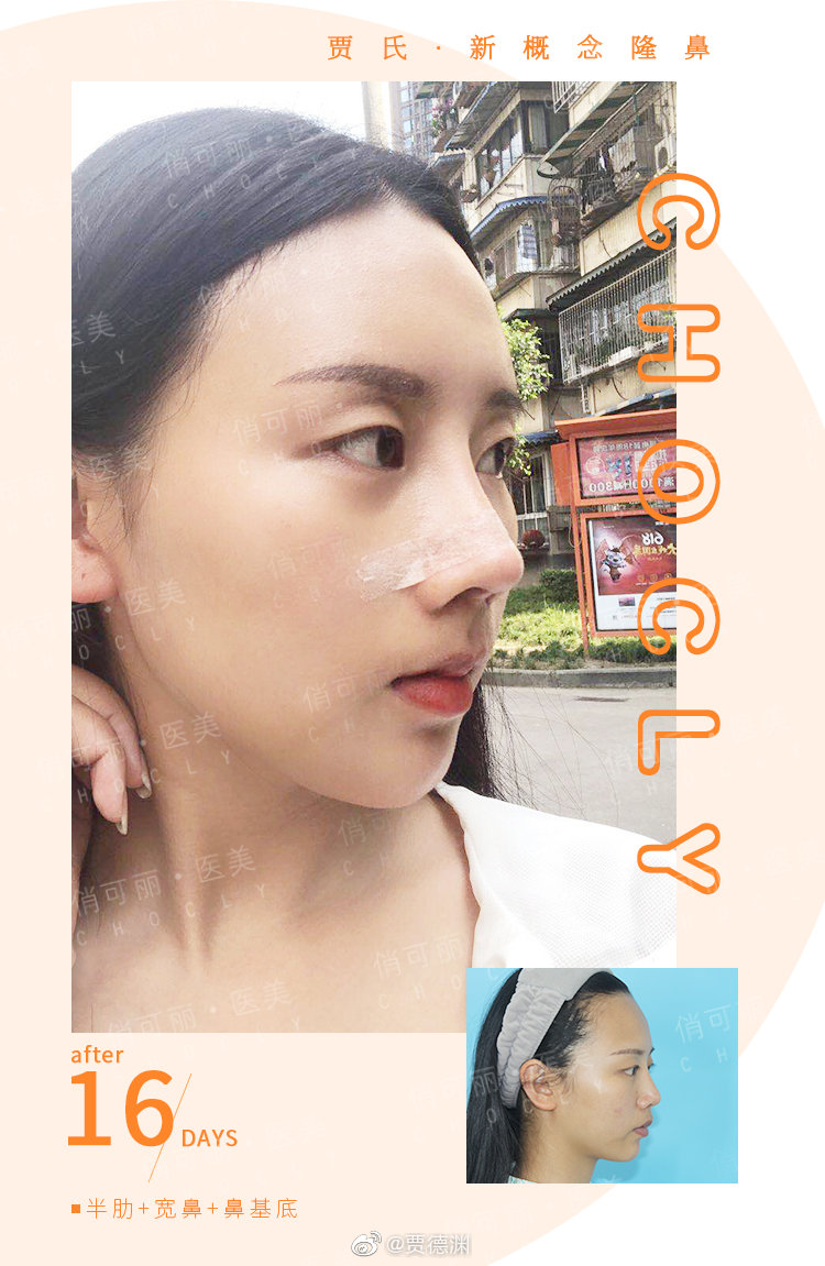 賈德淵隆鼻案例