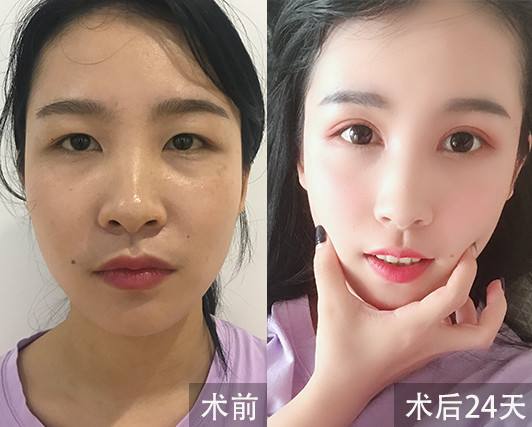 上海九院林曉曦、張余光做雙眼皮誰好?