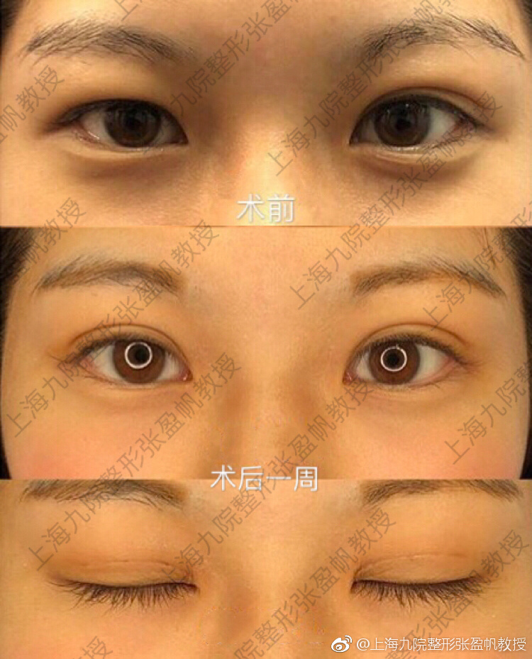 張盈帆雙眼皮案例