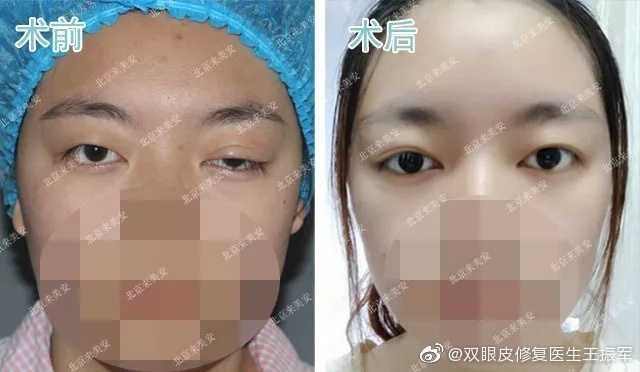 王振軍雙眼皮修復(fù)案例