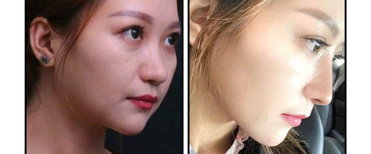 廣州羅延平和歐陽春哪個隆鼻技術好？貴不貴？