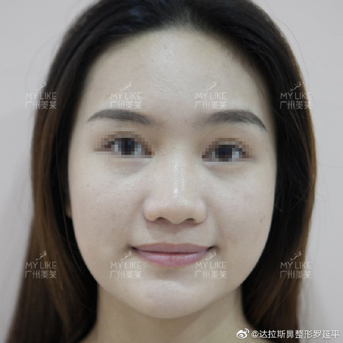 羅延平隆鼻案例