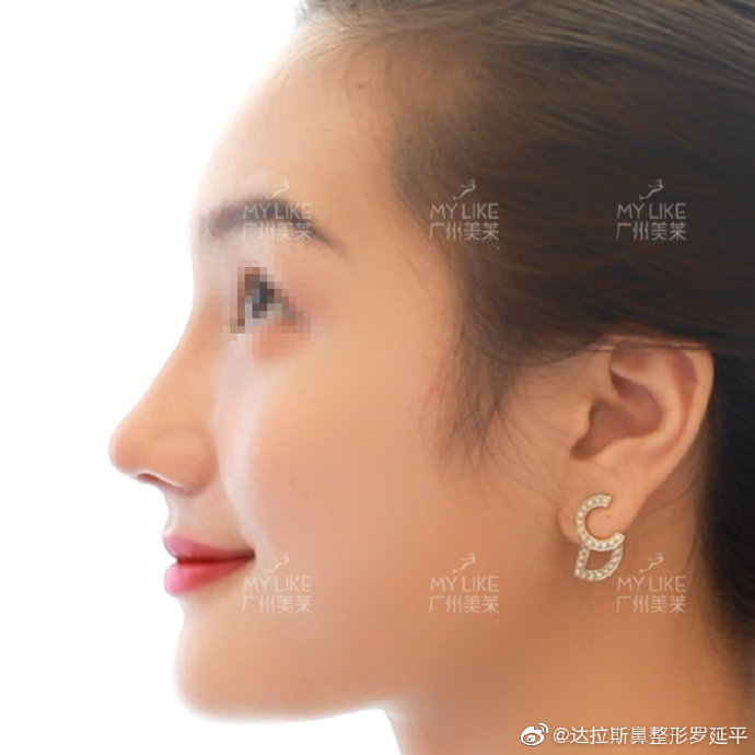 羅延平隆鼻案例