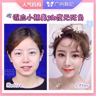 歐陽春隆鼻案例