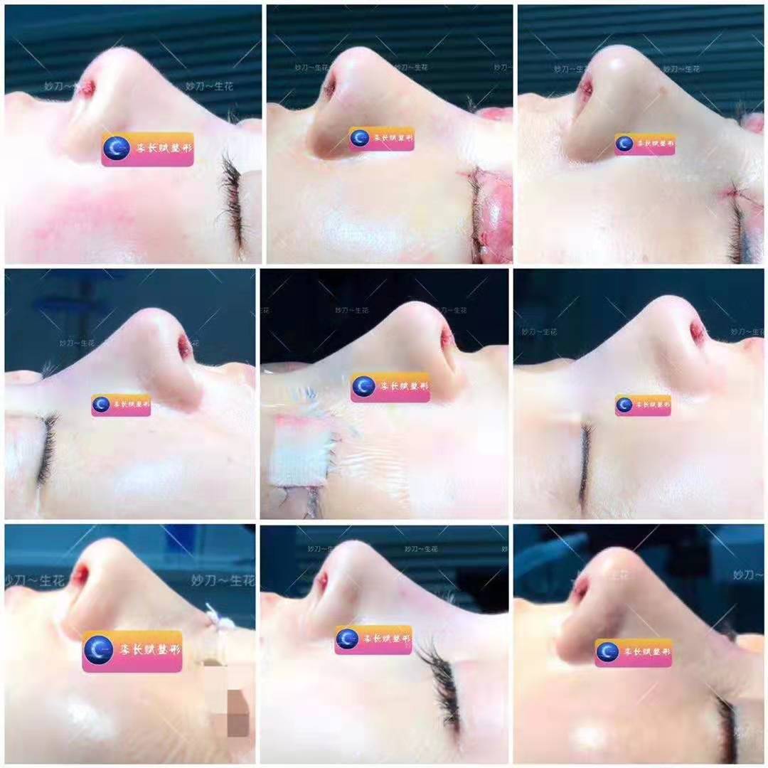 李長賦隆鼻案例