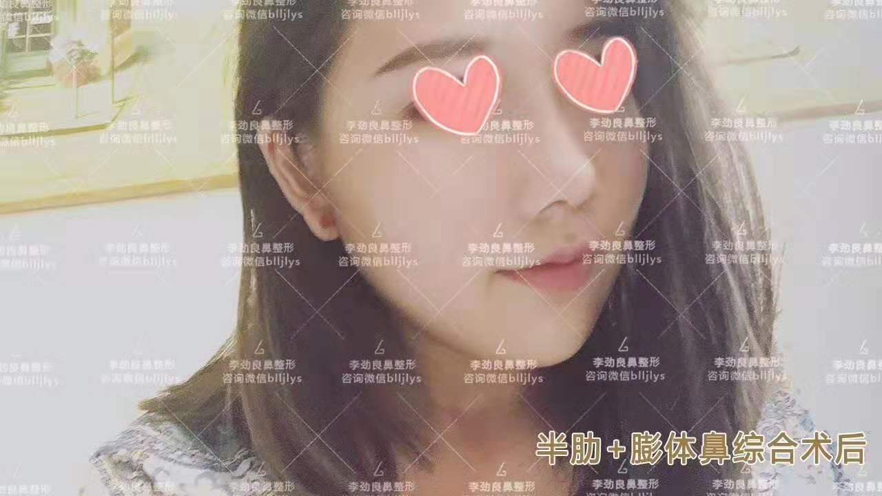 李勁良隆鼻案例