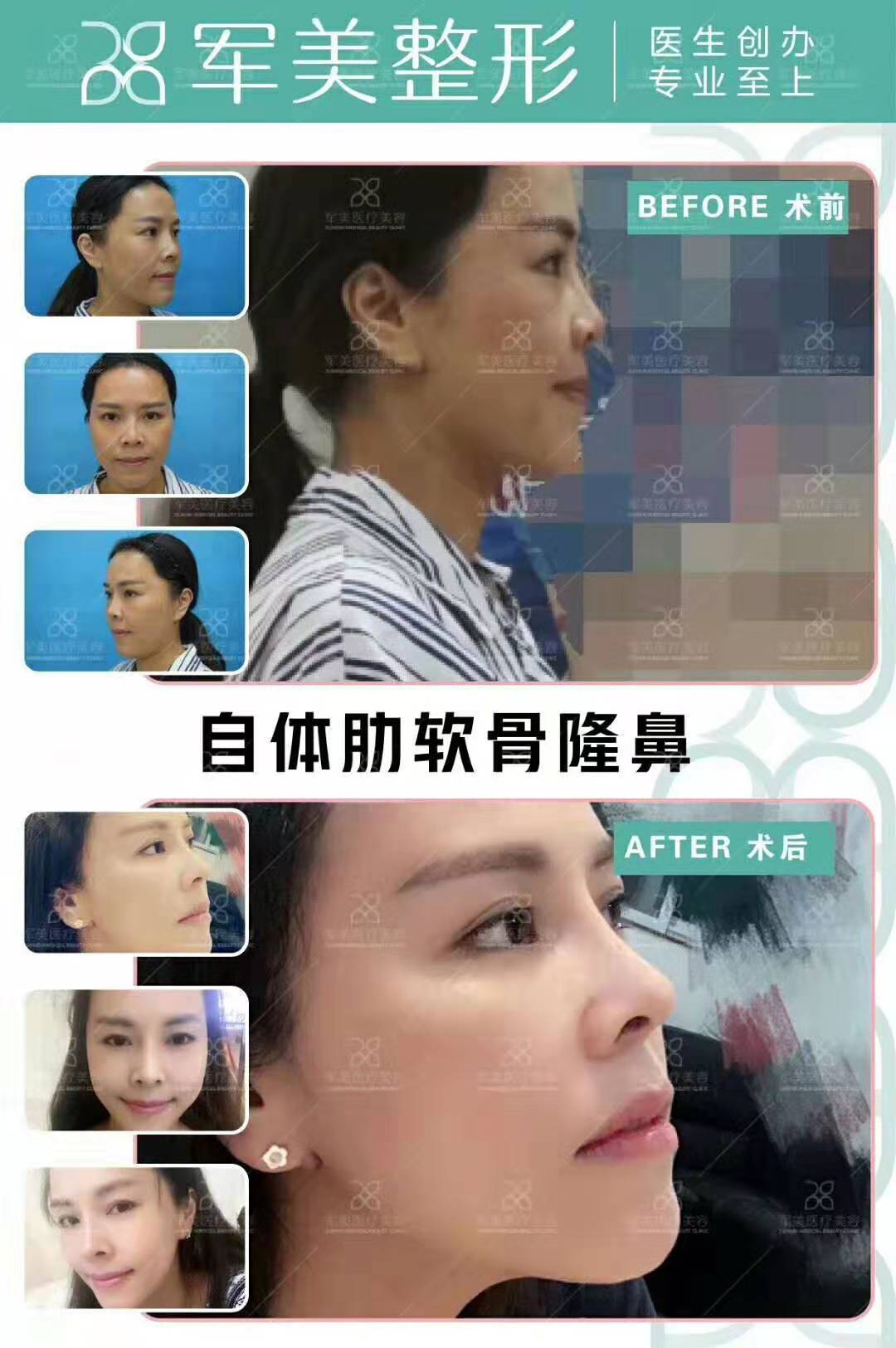 陳國成肋軟骨隆鼻案例