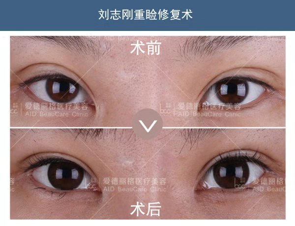 劉志剛雙眼皮修復(fù)案例