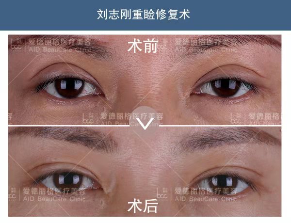 劉志剛雙眼皮修復(fù)案例