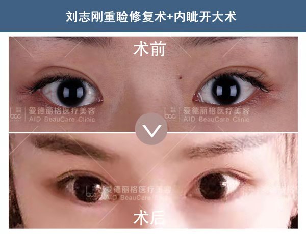 劉志剛雙眼皮修復(fù)案例