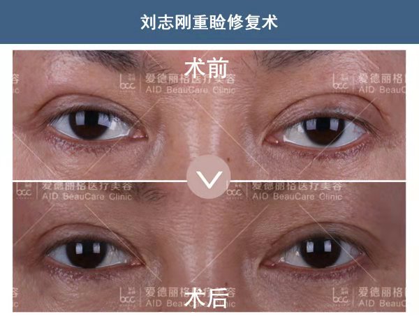 劉志剛雙眼皮修復(fù)案例