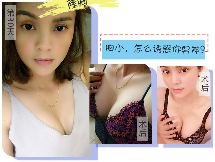 王世虎豐胸案例