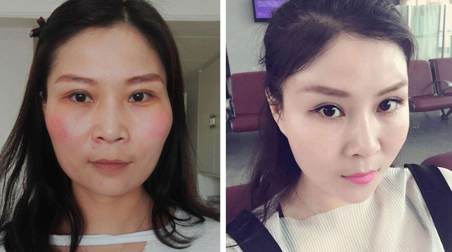 上海做面部填充哪個醫生最厲害？大概多少錢？