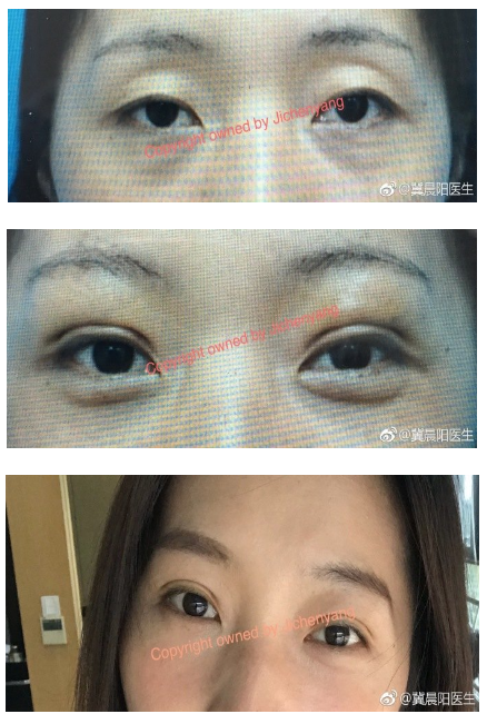 冀晨陽雙眼皮案例