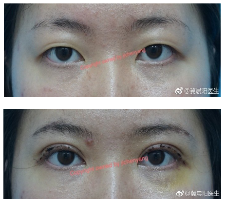 冀晨陽雙眼皮案例