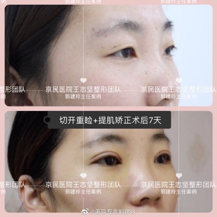 郭建玲眼綜合案例