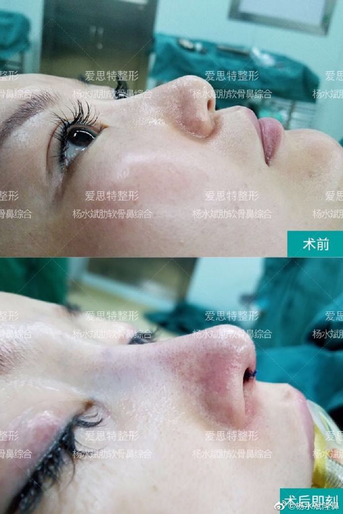 楊水斌隆鼻案例