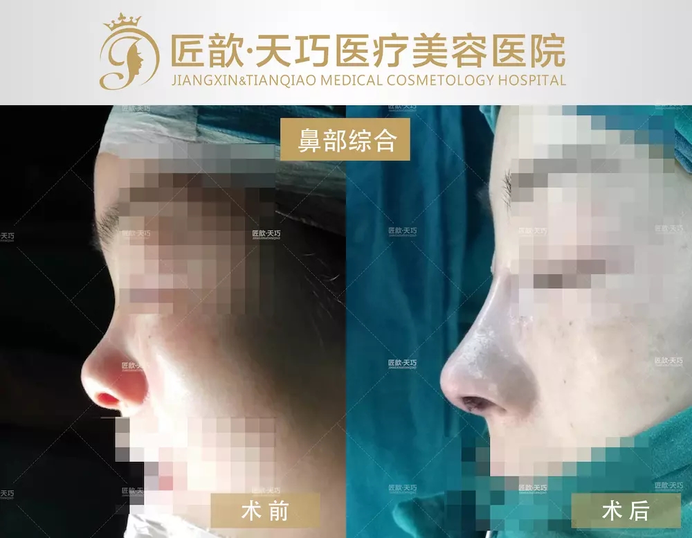 鄧裴鼻綜合案例