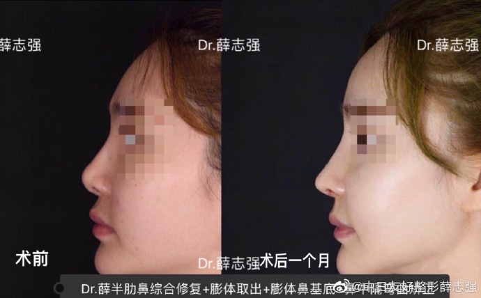 北京權(quán)威鼻修復(fù)專家都有哪些，大概價格多少？