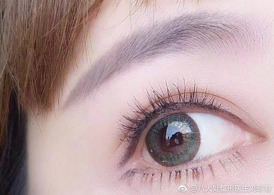 八大處整形醫(yī)院劉珍君做雙眼皮好不好？