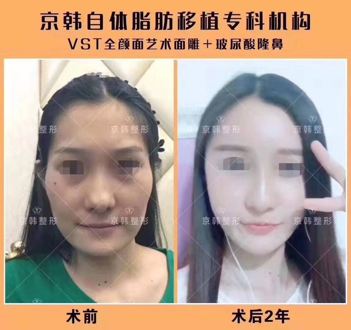 喬愛軍面部精雕案例