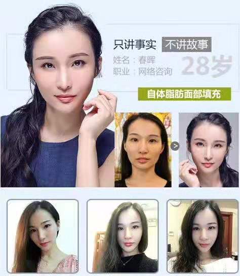 王勛面部精雕案例