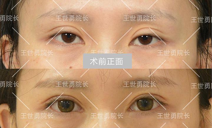 國(guó)內(nèi)知名度較高雙眼皮修復(fù)專家都有哪些?