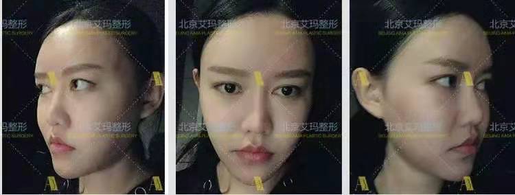 韋元強面部脂肪修復案例