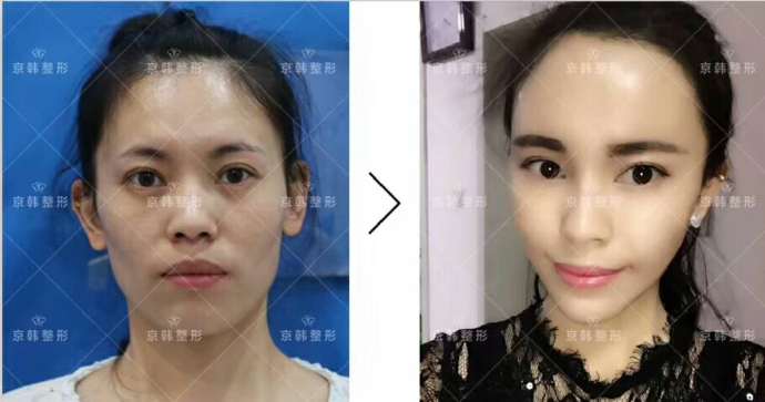 喬愛軍面部精雕案例